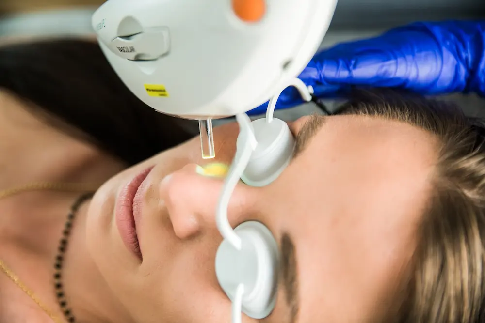 Laserowe leczenie rosacei platformą Stellar M22 — BodyMed Group